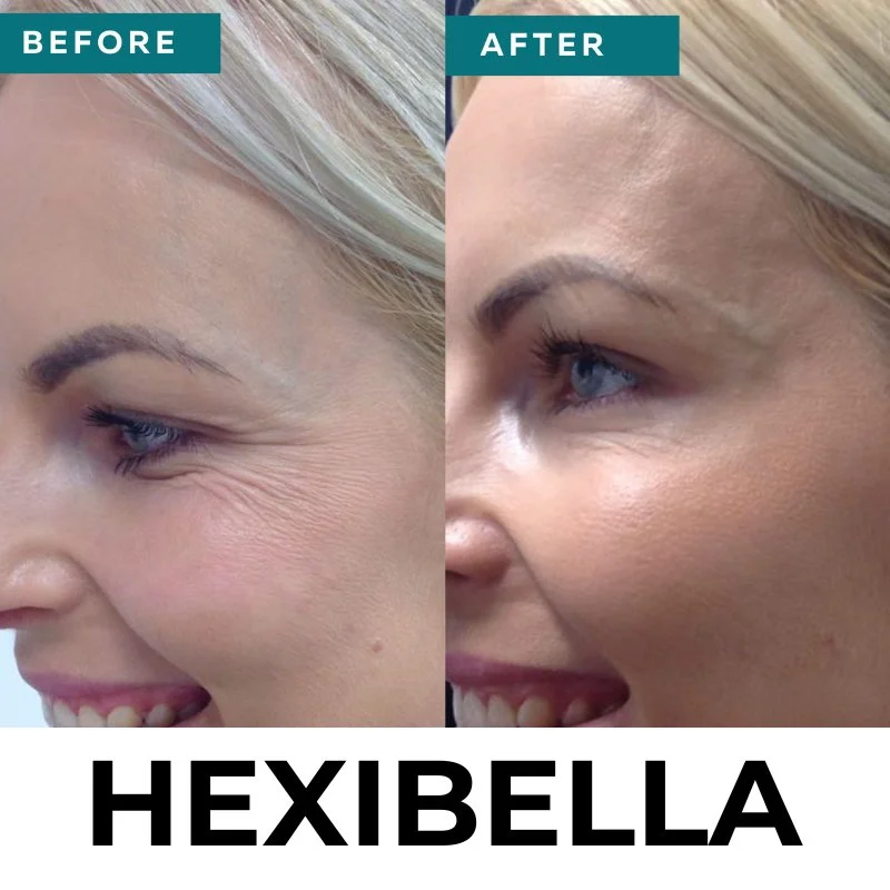 hexibella-004 Hexibella rood licht apparaat